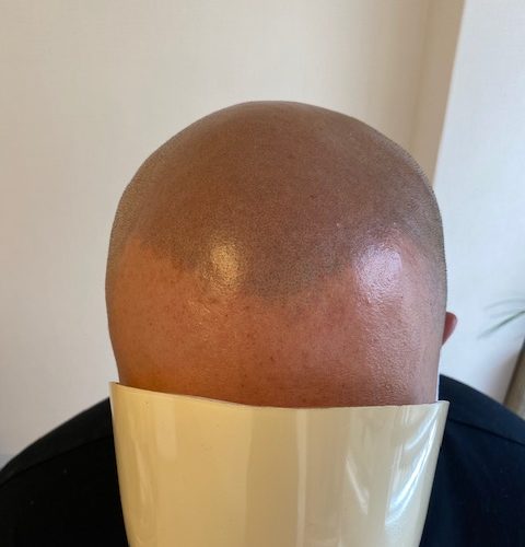 【アフター】完成から２ヶ月経った写真です。この色合いが馴染んだヘアタトゥーの感じですね。