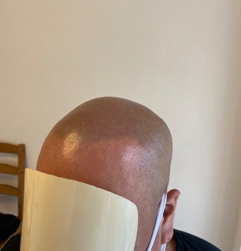 【アフター】自然な雰囲気のスキン坊主になりました。