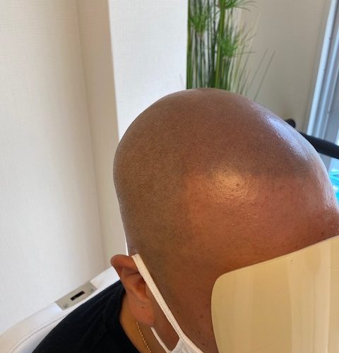 【アフター】サイドの自毛とも調和が取れています。