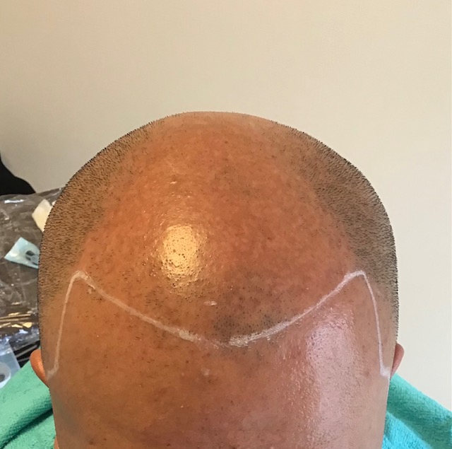 【ビフォー】　フロントラインができれば変わりそうですね。薄毛レベル５の場合、範囲が広いので、通常はドットの間隔を広めに打ちますが、インクのりが良いので初回から多めにドットを入れました。