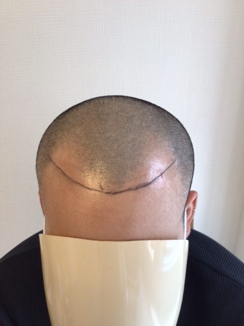 【ビフォー】M字が気になりますね。