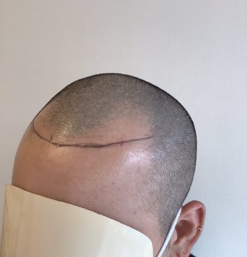 横から見るとM字の深さを更に感じます。