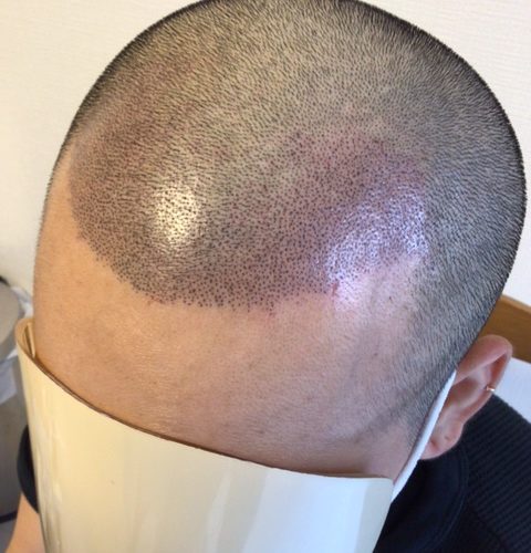 アップ画像です。施術直後で赤みがありますが、ドットの数、配列はわかると思います。自毛との違和感は無いです。