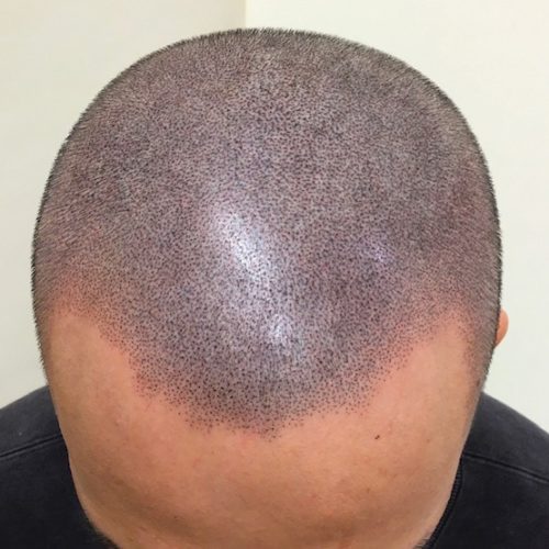 【最終施術直後】フロントラインを決め、ドットを全体的に足して完成です。