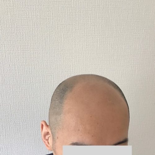 【ビフォー】この写真を見ればハチの濃い部分がわかると思います。