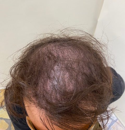 【初回施術後】髪の毛の色合いよりドットが薄いので、もの足りなさはありますが、肌色感は減っています。