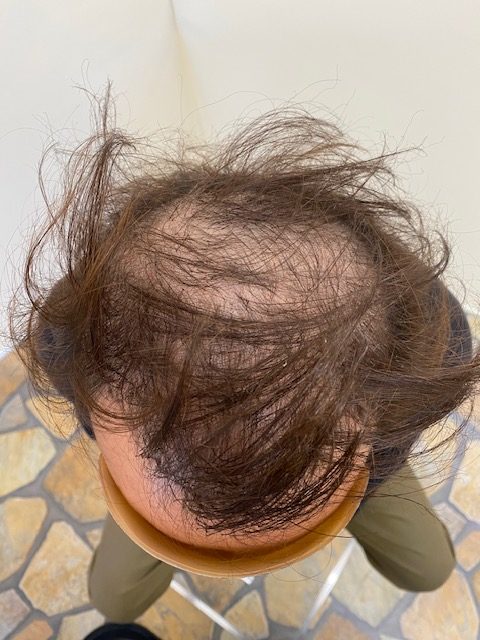 【ビフォー】頭頂部の頭皮が見えます。（肌色感）