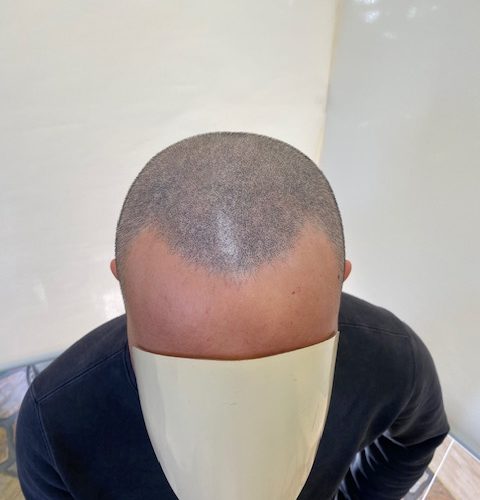 【上の写真を坊主にした時】髪が短くなると、この様に見えます。この施術は髪の長さとの関係が深いです。