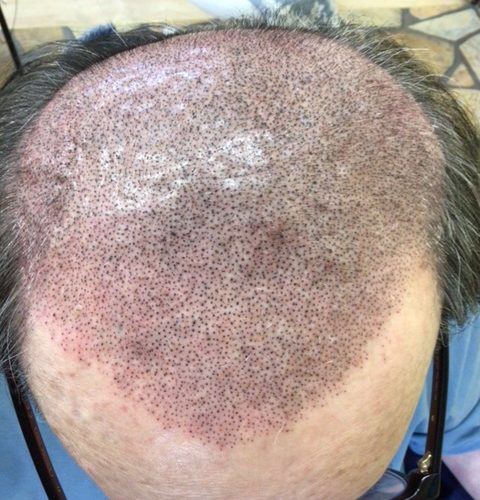 初回施術直後で赤みがあります。フロントラインは控えめです。