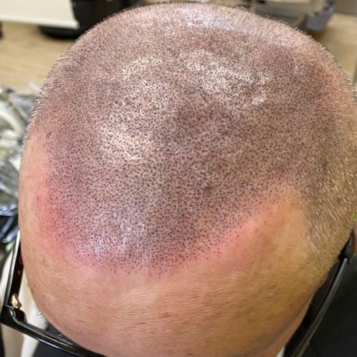 フロントラインはM字を感じるラインにして、やり過ぎ感を出さないようにしました。頭頂部はそれなりにしっかりと打ちました。