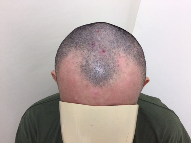 結構　深いM字です。頭頂部も少しカバーした方が良さそうです。