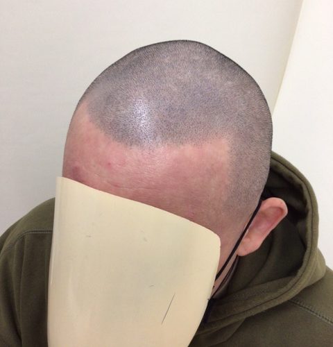 メンテナンスはフロント中央・頭頂部の自毛が減ってきた時かと思います。