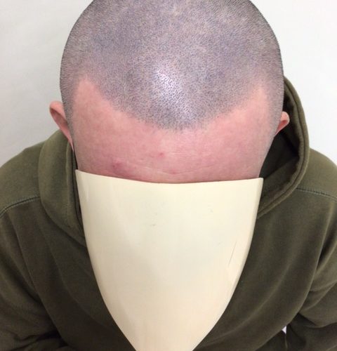 完成です！　M字薄毛では無くなりました。