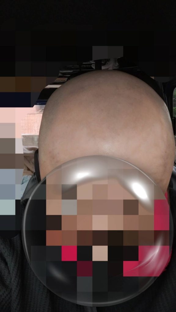 【ビフォー】前方からは髪の存在を感じません。