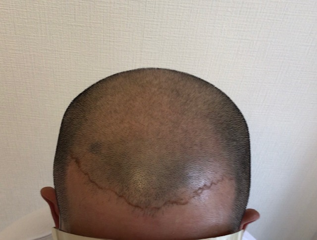 頭頂部の頭皮が目立ちますね。