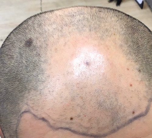 肌が白く髪が太い方も0.5mmが適しています。そして頭部ハチ部分に髪が多い方も0.5mmが良いでしょう。