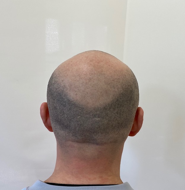 後頭部は頭部全体の中でもいちばん自毛密度が高い部位なので、この部分に濃さを合わせるのですが、この方のように高密度の黒髪の場合は0.5mm坊主でないと合わせが難しくなります。
