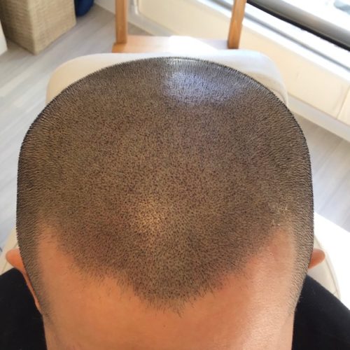 フロントラインも凸凹にできます。自由自在です。左右対称のフロントラインはちょっと、、。いい感じになったと思います。